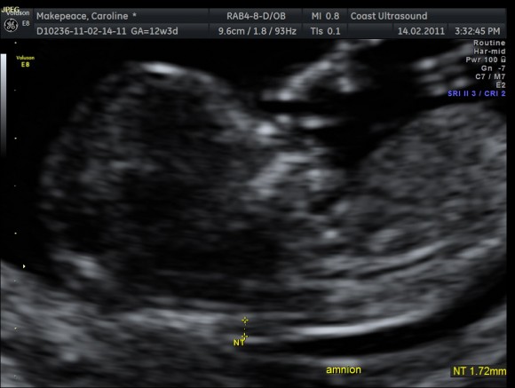 a ultrasound picture